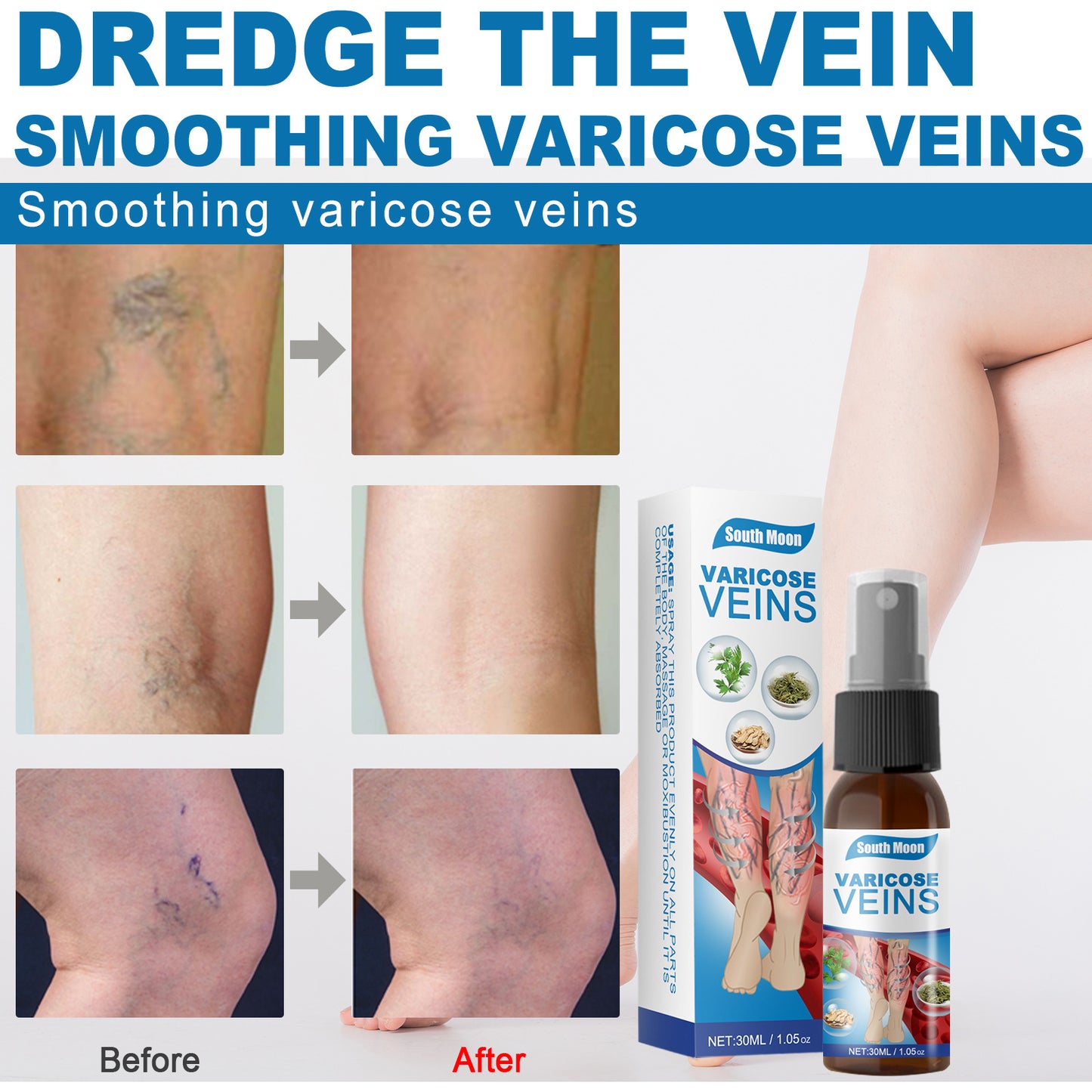 30ml Varicose Veins Treatment Spray Varicose Vein Treatment Cream Repair Varicocele Removal Pain Relief Kidney Inflammation Legs Vein Health Care Spray